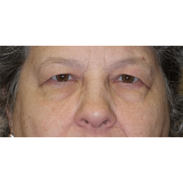Before Image: Upper Blepharoplasty - front