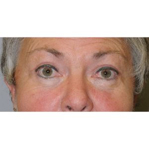 Eyelid Surgery, Facelift and Necklift