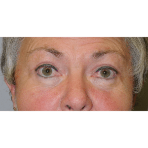 After Image: Eyelid Surgery, Facelift and Necklift