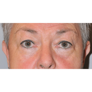 Before Image: Eyelid Surgery, Facelift and Necklift