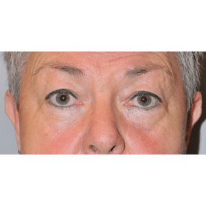 Eyelid Surgery, Facelift and Necklift