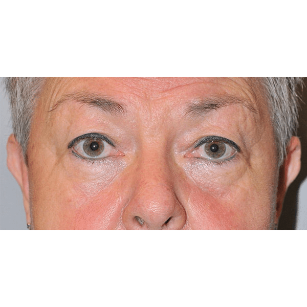 Before Image: Eyelid Surgery, Facelift and Necklift - front