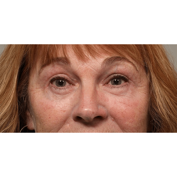 After Image: Endoscopic Browlift, Upper & Lower Blepharoplasty and Ptosis Repair - front