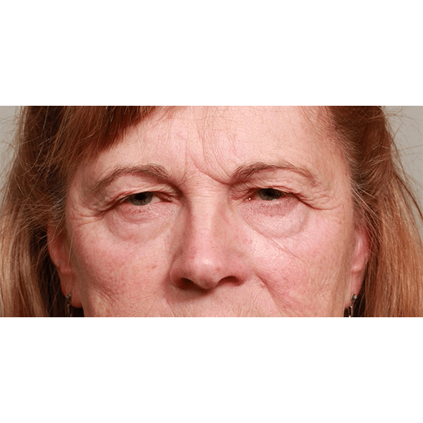 Before Image: Endoscopic Browlift, Upper & Lower Blepharoplasty and Ptosis Repair - front