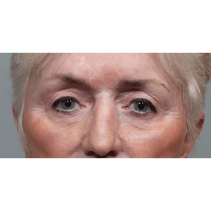 After Image: Upper and Lower Blepharoplasty with Restylane to Cheeks