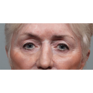 Upper and Lower Blepharoplasty with Restylane to Cheeks