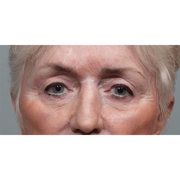 After Image: Upper and Lower Blepharoplasty with Restylane to Cheeks - front