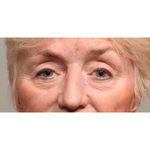 Upper and Lower Blepharoplasty with Restylane to Cheeks