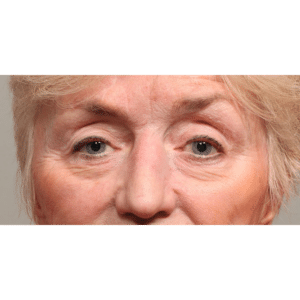 Before Image: Upper and Lower Blepharoplasty with Restylane to Cheeks