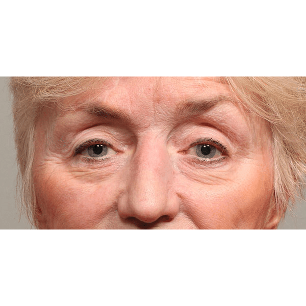 Before Image: Upper and Lower Blepharoplasty with Restylane to Cheeks - front