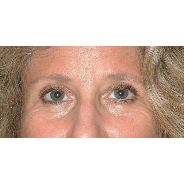 After Image: Upper & Lower Blepharoplasty - front