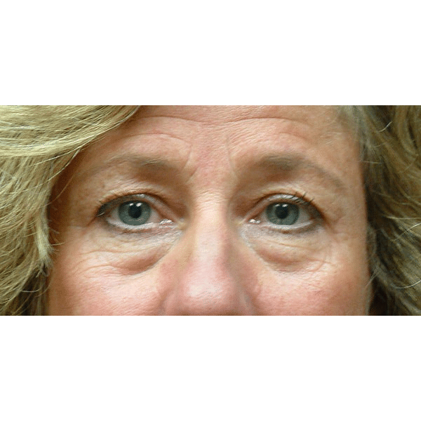 Before Image: Upper & Lower Blepharoplasty - front