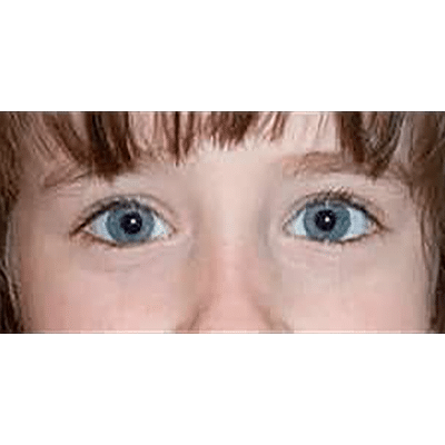 After Image: Ptosis Repair - front