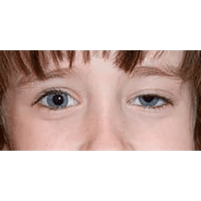 Before Image: Ptosis Repair - front