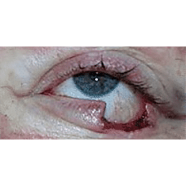 After Image: Lid Tumors - front