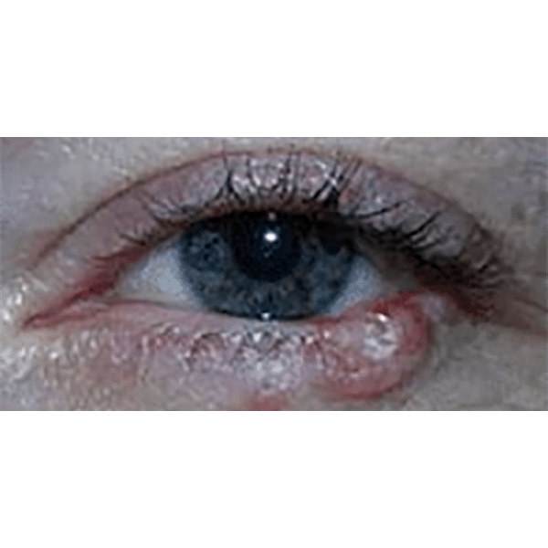 Before Image: Lid Tumors - front