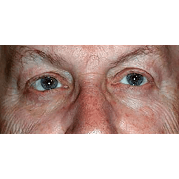 After Image: Eyelid Cancer and Reconstruction - front