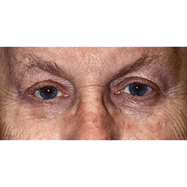 Before Image: Eyelid Cancer and Reconstruction - front