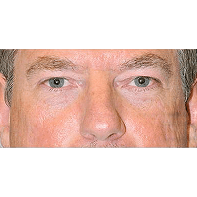 After Image: Ptosis Repair - front