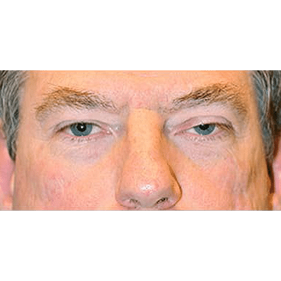 Before Image: Ptosis Repair - front