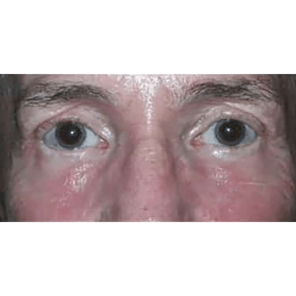 After Image: Laser Resurfacing - front