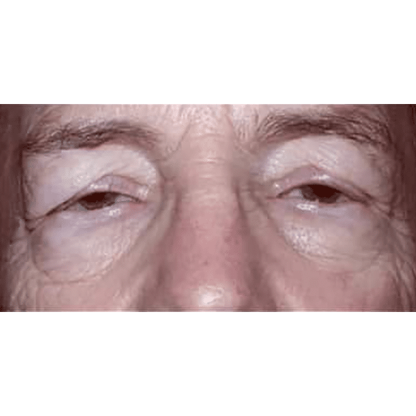 Before Image: Laser Resurfacing - front