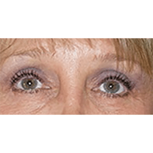 After Image: Facelift and Upper Blepharoplasty