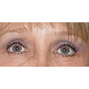 Facelift and Upper Blepharoplasty