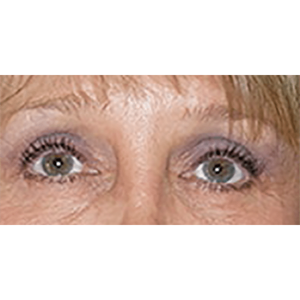 After Image: Facelift and Upper Blepharoplasty - front
