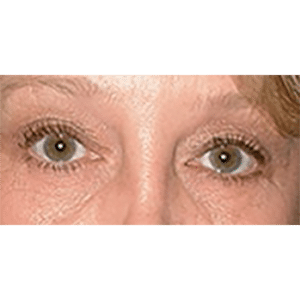 Before Image: Facelift and Upper Blepharoplasty