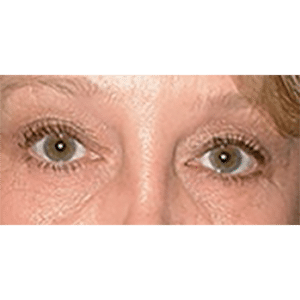 Facelift and Upper Blepharoplasty