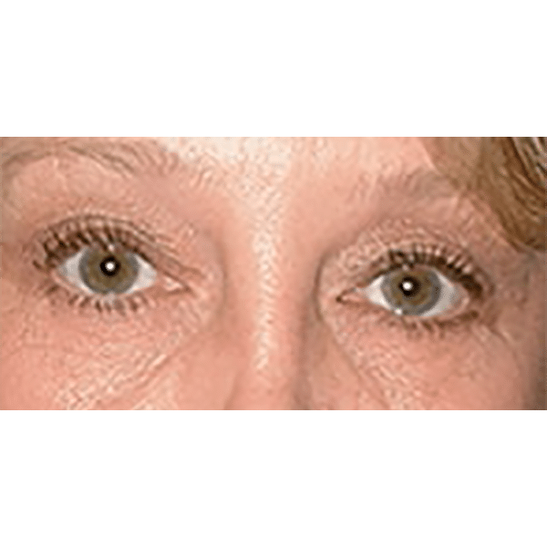 Before Image: Facelift and Upper Blepharoplasty - front