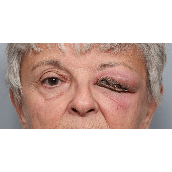 Before Image: Orbital Celulitis - front