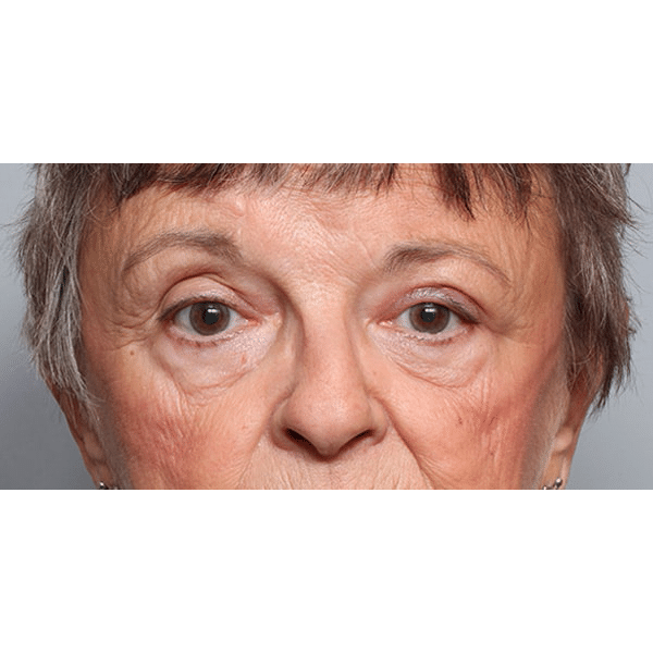 After Image: Orbital Celulitis - front