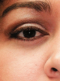 After Image: Thyroid Eye Disease (Graves’) - front
