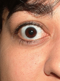 Before Image: Thyroid Eye Disease (Graves’) - front