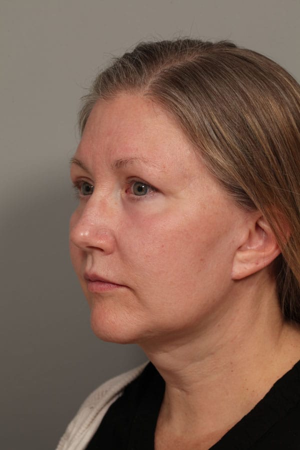 After Image: Facelift, Necklift, Upper & Lower Blepharoplasty, Laser Resurfacing, Fat Transfer to Perioral and Lips - left-front-oblique