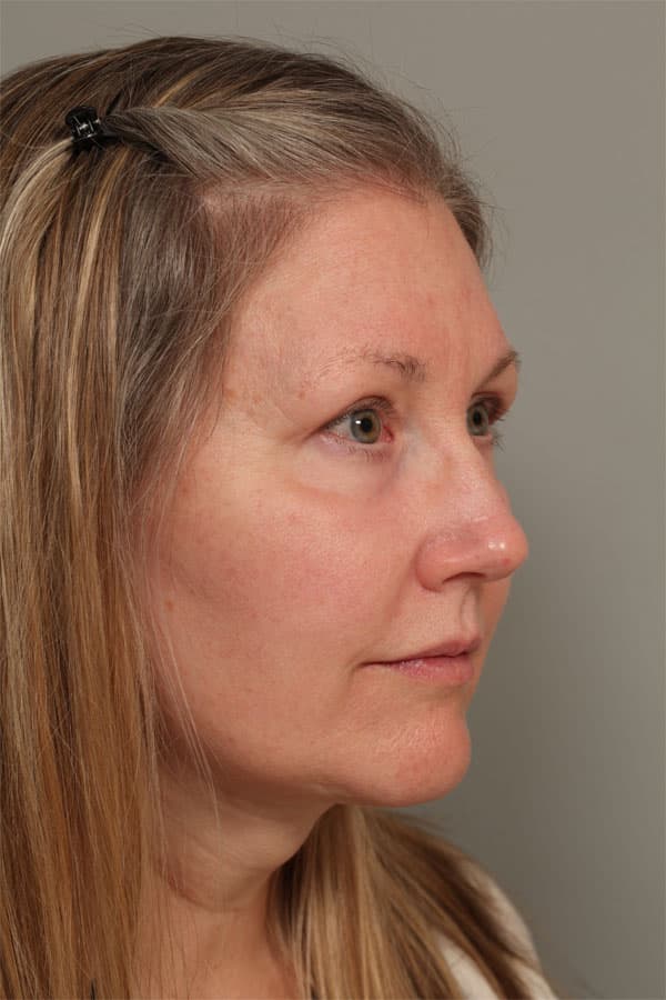 After Image: Facelift, Necklift, Upper & Lower Blepharoplasty, Laser Resurfacing, Fat Transfer to Perioral and Lips - right-front-oblique
