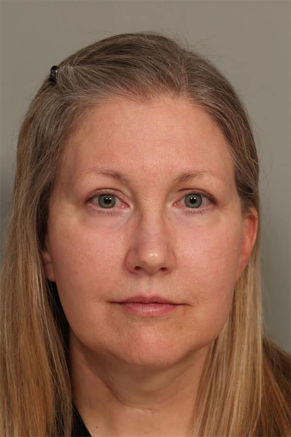 After Image: Facelift, Necklift, Upper & Lower Blepharoplasty, Laser Resurfacing, Fat Transfer to Perioral and Lips - front