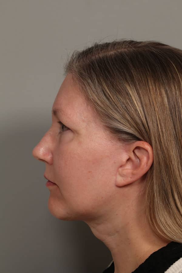 After Image: Facelift, Necklift, Upper & Lower Blepharoplasty, Laser Resurfacing, Fat Transfer to Perioral and Lips - front