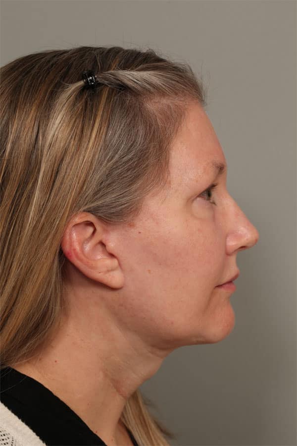 After Image: Facelift, Necklift, Upper & Lower Blepharoplasty, Laser Resurfacing, Fat Transfer to Perioral and Lips - front