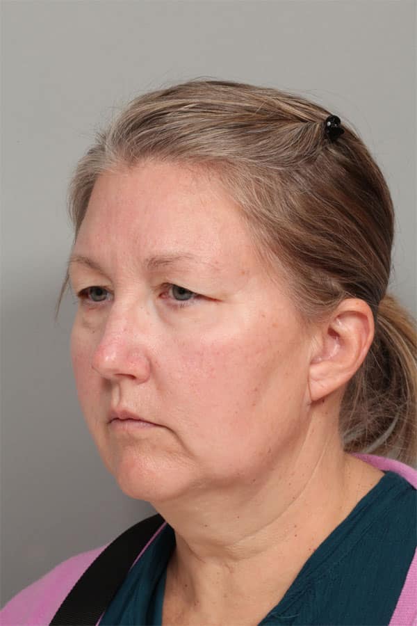 Before Image: Facelift, Necklift, Upper & Lower Blepharoplasty, Laser Resurfacing, Fat Transfer to Perioral and Lips - left-front-oblique