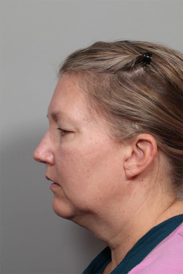 Before Image: Facelift, Necklift, Upper & Lower Blepharoplasty, Laser Resurfacing, Fat Transfer to Perioral and Lips - front