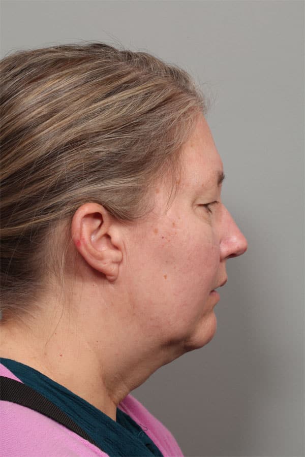 Before Image: Facelift, Necklift, Upper & Lower Blepharoplasty, Laser Resurfacing, Fat Transfer to Perioral and Lips - front
