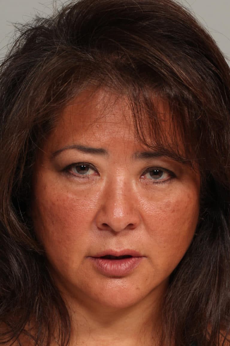 Before Image: Asian Blepharoplasty - front