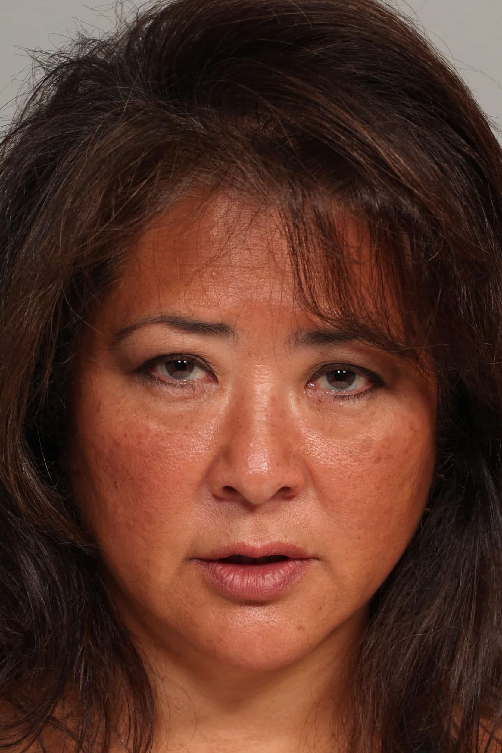 Before Image: Asian Blepharoplasty - front
