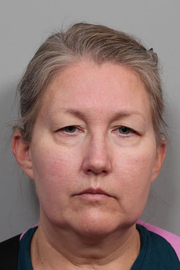 Before Image: Facelift, Necklift, Upper & Lower Blepharoplasty, Laser Resurfacing, Fat Transfer to Perioral and Lips - front