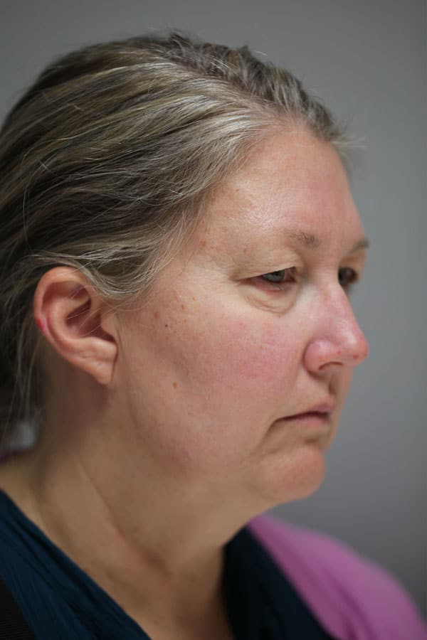 Before Image: Facelift, Necklift, Upper & Lower Blepharoplasty, Laser Resurfacing, Fat Transfer to Perioral and Lips - right-front-oblique