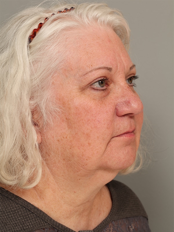 After Image: Upper Blepharoplasty with Xanathelasma Excision - right-front-oblique