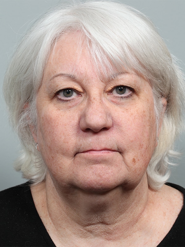 Before Image: Upper Blepharoplasty with Xanathelasma Excision - front